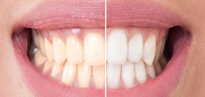 दांतों का पीलापन हटाने के लिए घरेलू उपाय