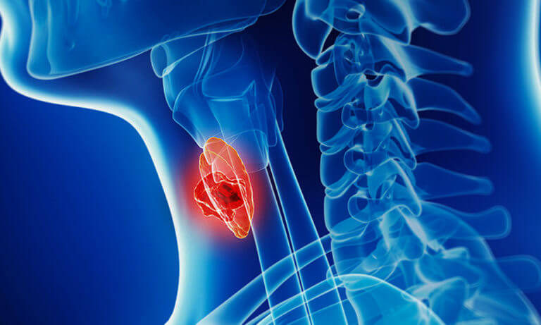 क्या हैं गले में कैंसर की गांठ की पहचान? लक्षण, कारण और इलाज