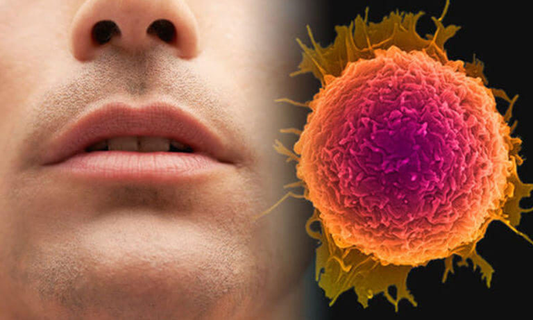 मुंह का कैंसर के शुरुआती लक्षण, कारण, पहचान और होम्योपैथिक दवा